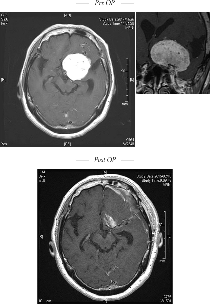 脳腫瘍 ｜ Takuro Inoue MD, PhD. 井上卓郎｜湖東記念病院脳神経外科 